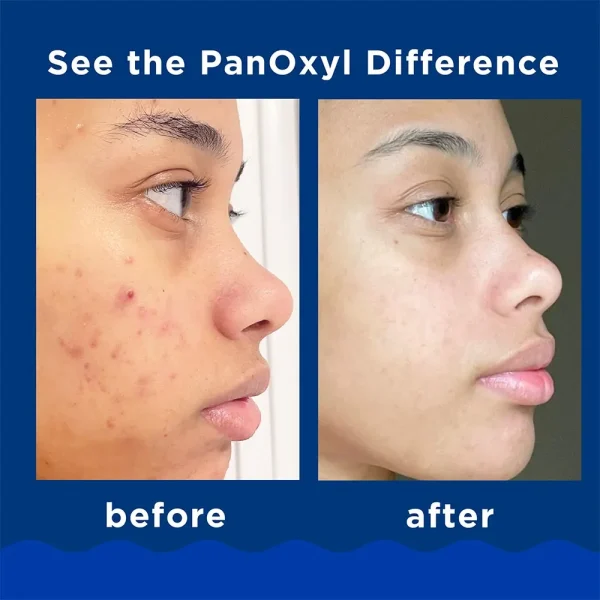 PanOxyl Acne Foaming Wash Benzoyl Peroxide 10% Maximum Strength 156g - Image 3